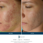 Microneedling Treatment after and before Image | Meridian Medical Spa | Magnolia Ave, Riverside, CA ,United States
