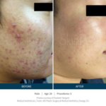 Microneedling Treatment after and before Image | Meridian Medical Spa | Magnolia Ave, Riverside, CA ,United States
