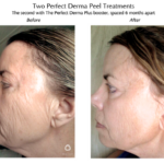 Perfect Peel / Chemical Peels treatment after and before Image | Meridian Medical Spa | Magnolia Ave, Riverside, CA ,United States