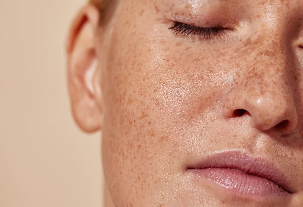 Melasma Treatment in Bonita Springs & Naples, FL