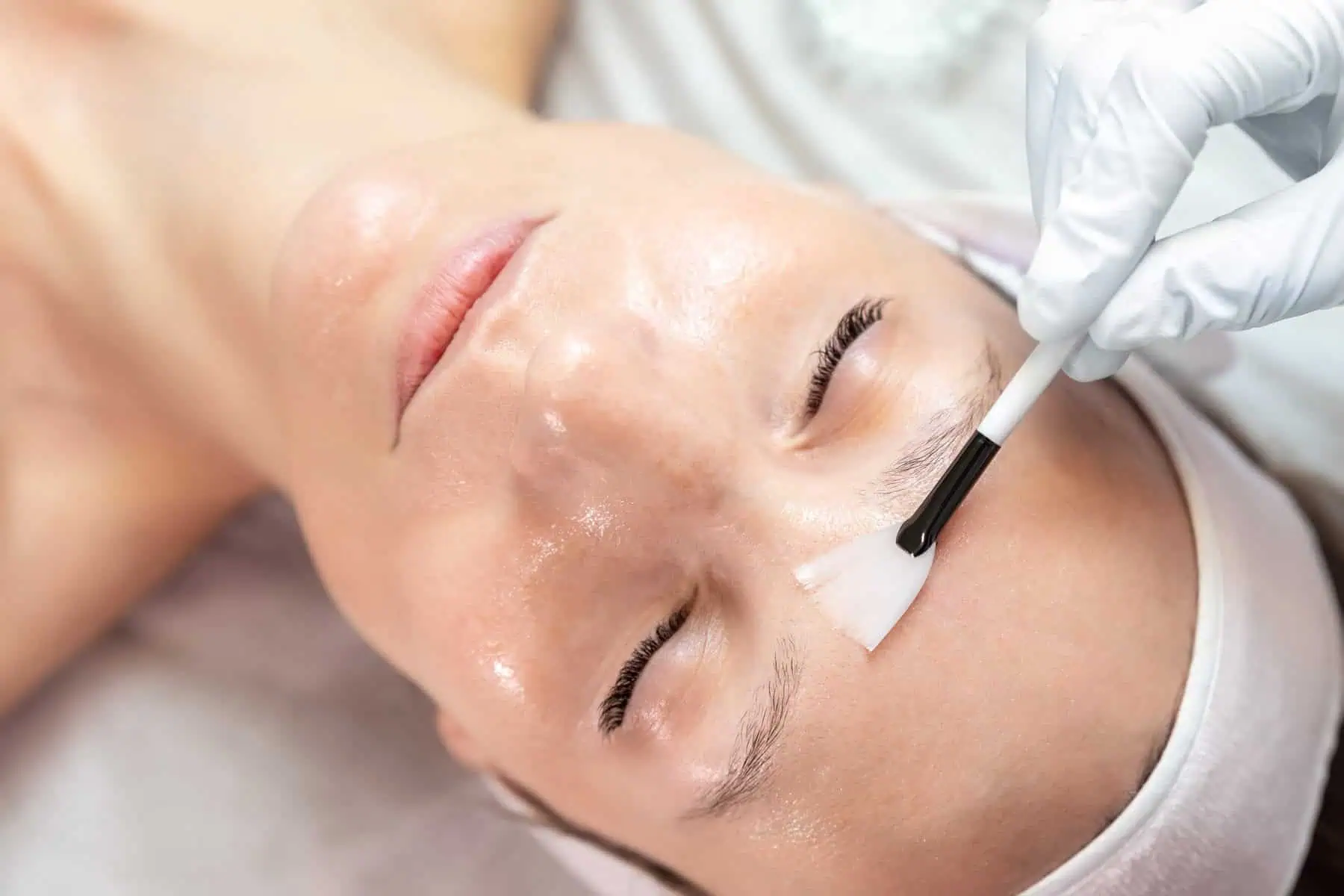 PRX-T33 Peel Treatment at Meridian Medical Spa in Bonita