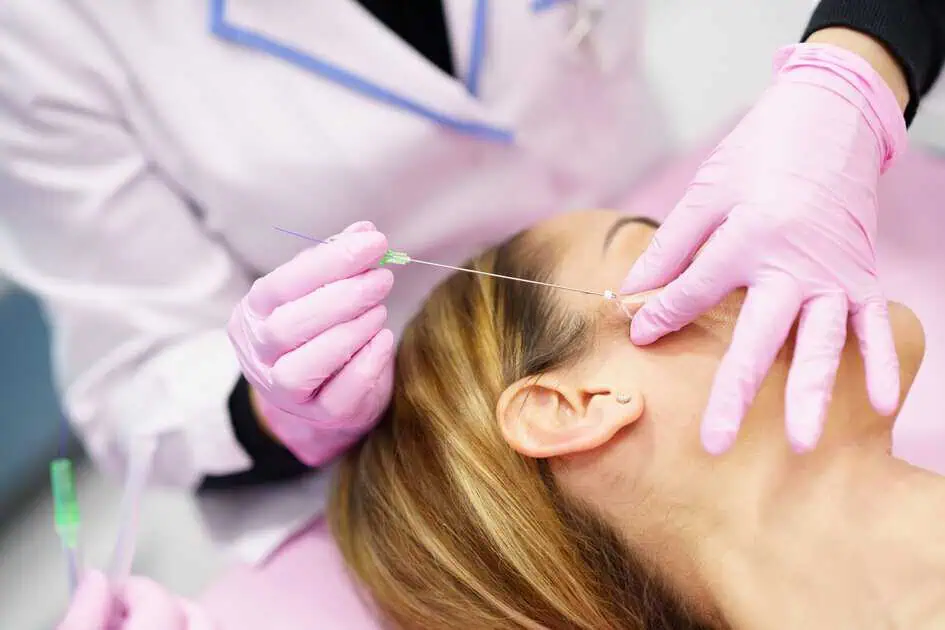 PDO Threads Lift in Bonita Springs, FL by Meridian MedSpa
