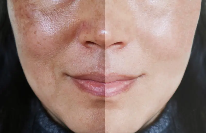 Transform Your Skin with PRX-T33_ The Non-Invasive Peel That Rejuvenates