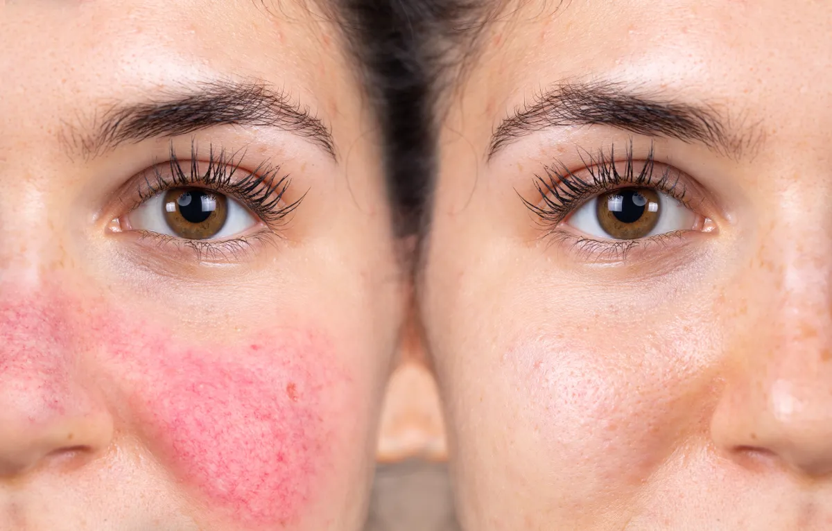 Acne Scars