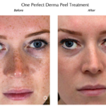 Perfect Peel / Chemical Peels treatment after and before Image | Meridian Medical Spa | Magnolia Ave, Riverside, CA ,United States