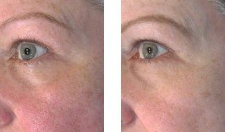 Before and after Images of Microneedling Treatment I Meridian Medical Spa | Magnolia Ave, Riverside, CA ,United States