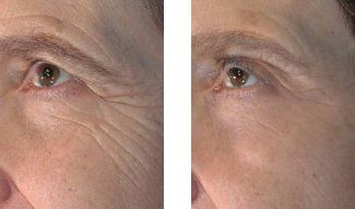 Before and after Images of Microneedling Treatment I Meridian Medical Spa | Magnolia Ave, Riverside, CA ,United States