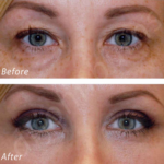 Before and After Treatment photos | Plasma Pen | | Meridian Medical Spa | Magnolia Ave, Riverside, CA ,United States