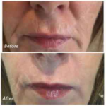 Before and After Treatment photos | Plasma Pen | | Meridian Medical Spa | Magnolia Ave, Riverside, CA ,United States